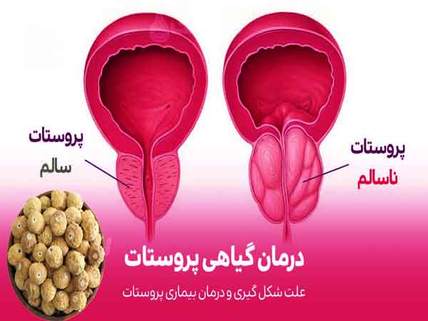 پروستات یک غده مهم در سیستم تناسلی مردان است که وظیف تولید مایع منی را بر عهده دارد. بیماری‌ های پروستات، از جمله التهاب پروستات (پروستاتیت) زخم غیرسرطانی پروستات  مشکلات شایعی هستند که بر روی کیفیت زندگی مردان تأثیری‌گذارند.  ترکیبات شیمیایی انجیر انجیر یک میوه خوراکی است که در بسیاری از مناطق جهان ...